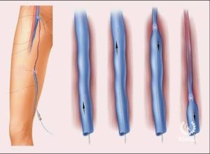 How is endovascular laser leg varicose vein therapy implemented?