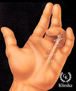 Контрактура Дюпюитрена (ограничения подвижности пальцев)