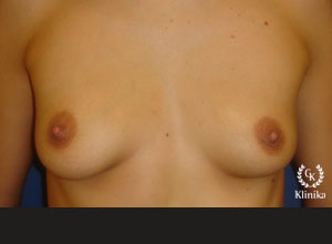 Vaizdas prieš krūtų plastinę operaciją
