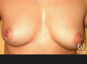 Vaizdas prieš krūtų plastinę operaciją