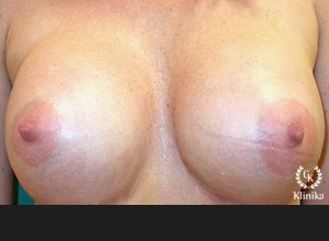 Vaizdas po krūtų plastinė operacijos