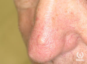 Bazoląstelinis odos vėžys (bazalioma) po gydymo lazeriu