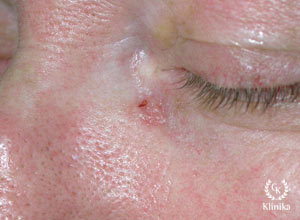 Bazoląstelinis odos vėžys (bazalioma) prieš gydymą