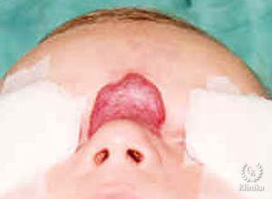 Įgimta vaikų hemangioma - vaizdas prieš gydymą