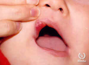 Įgimta vaikų hemangioma - vaizdas po gydymo