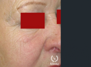 Frakcinis odos atnaujinimas - prieš procedūrą