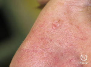 Bazoląstelinis odos vėžys (bazalioma) prieš gydymą