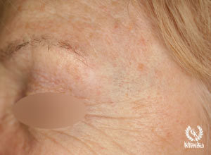Bazoląstelinis odos vėžys (bazalioma) po gydymo lazeriu